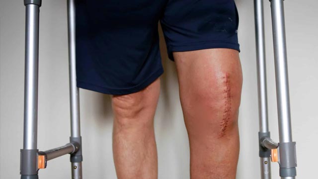When Knee Replacement Becomes the Clear Path to Relief